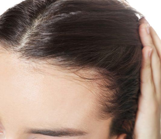 Geheimratsecken bei Frauen: Ursachen und Behandlung