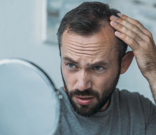 Minoxidil gegen Haarausfall: Wirkung, Nebenwirkungen, Anwendung