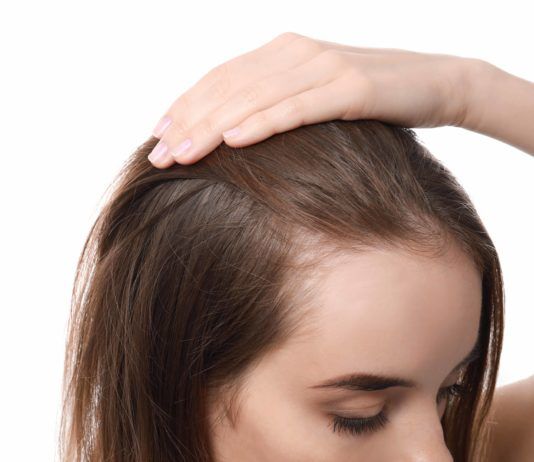 Kreisrunder Haarausfall bei Frauen: Ursachen & Behandlung