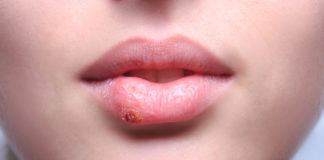 Zink gegen Herpes – Wirkt das wirklich? Was ist besser: Tabletten oder Zinksalbe bei Herpes