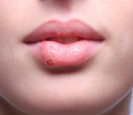 Zink gegen Herpes – Wirkt das wirklich? Was ist besser: Tabletten oder Zinksalbe bei Herpes