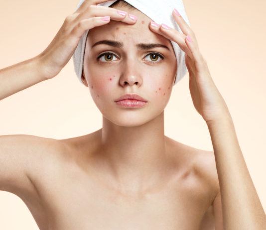 Zinktabletten gegen Pickel und Akne – Zink macht die Haut schön!